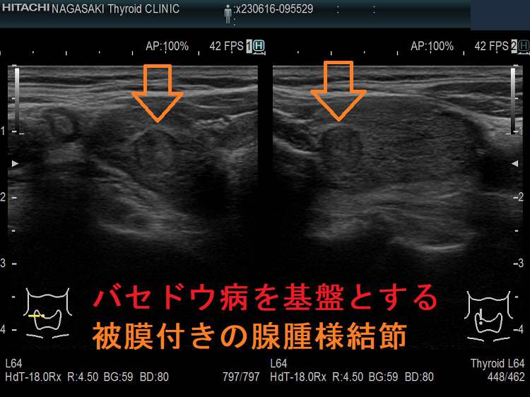 バセドウ病を基盤とする被膜付きの腺腫様結節 バセドウ病を基盤とする被膜付きの腺腫様結節