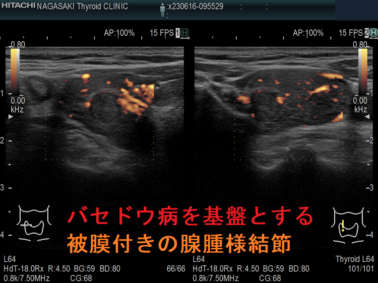 バセドウ病を基盤とする被膜付きの腺腫様結節 ドプラーモード バセドウ病を基盤とする被膜付きの腺腫様結節 ドプラーモード