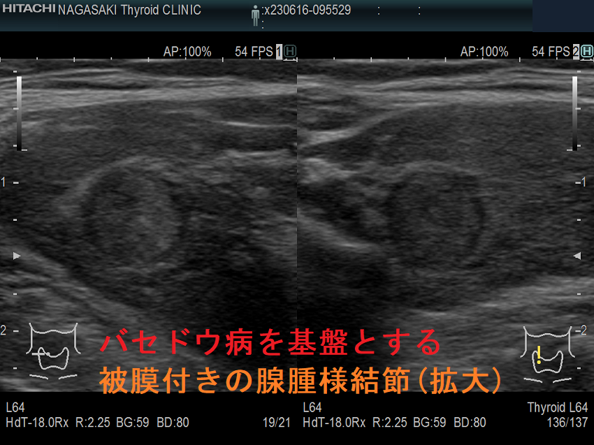 バセドウ病を基盤とする被膜付きの腺腫様結節(拡大) バセドウ病を基盤とする被膜付きの腺腫様結節(拡大)