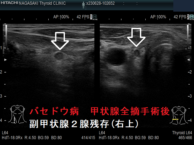 バセドウ病 甲状腺全摘手術後 副甲状腺2腺残存(右上) バセドウ病 甲状腺全摘手術後 副甲状腺2腺残存(右上)