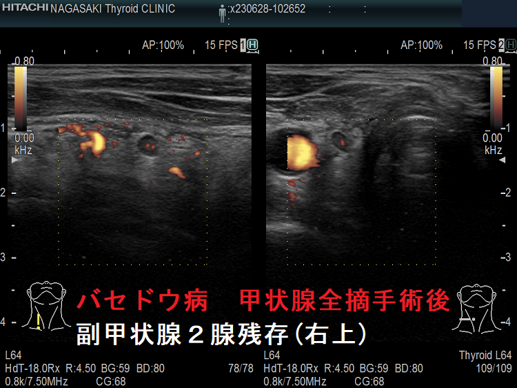バセドウ病 甲状腺全摘手術後 副甲状腺2腺残存(右上) ドプラーモード バセドウ病 甲状腺全摘手術後 副甲状腺2腺残存(右上) ドプラーモード