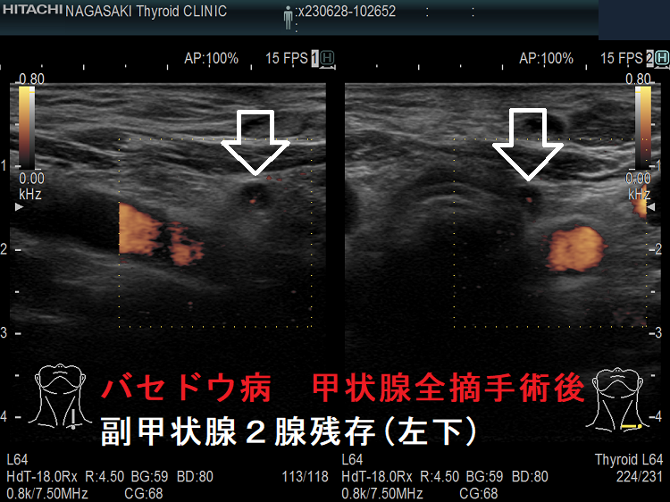 バセドウ病 甲状腺全摘手術後 副甲状腺2腺残存(左下) バセドウ病 甲状腺全摘手術後 副甲状腺2腺残存(左下)