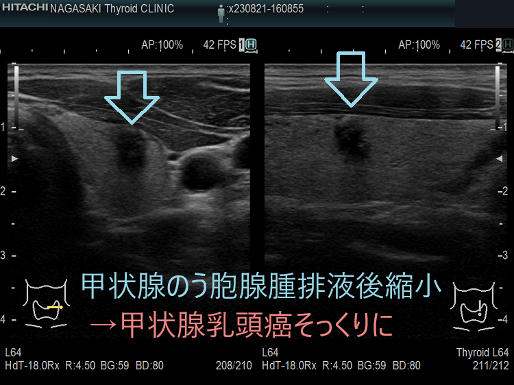 甲状腺のう胞腺腫排液後縮小→甲状腺乳頭癌そっくりに1 甲状腺のう胞腺腫排液後縮小→甲状腺乳頭癌そっくりに1