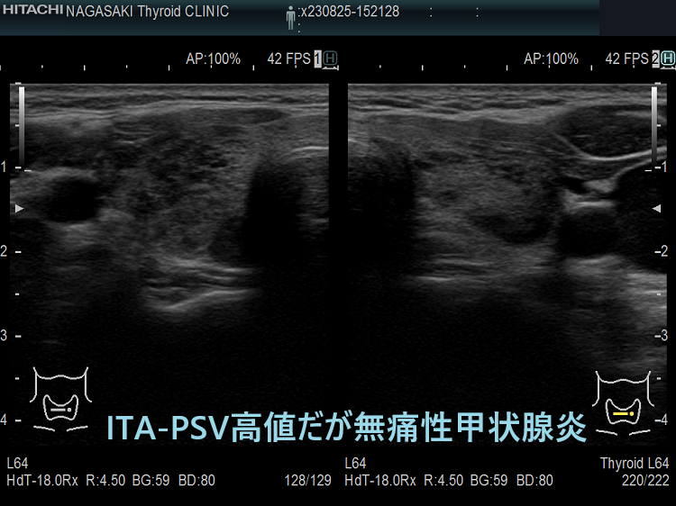 下甲状腺動脈の収縮期最大血流速度(ITA-PSV)高値だが無痛性甲状腺炎 下甲状腺動脈の収縮期最大血流速度(ITA-PSV)高値だが無痛性甲状腺炎