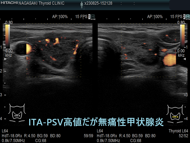 無痛性甲状腺炎とバセドウ病の鑑別[橋本病 超音波エコー 甲状腺中毒症