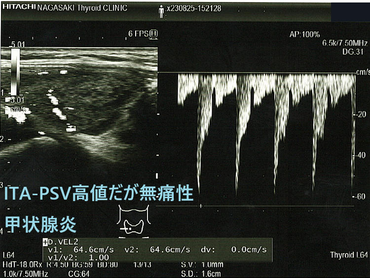 無痛性甲状腺炎とバセドウ病の鑑別[橋本病 超音波エコー 甲状腺中毒症