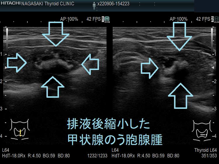 排液後縮小した甲状腺のう胞腺腫 超音波(エコー)画像 排液後縮小した甲状腺のう胞腺腫 超音波(エコー)画像