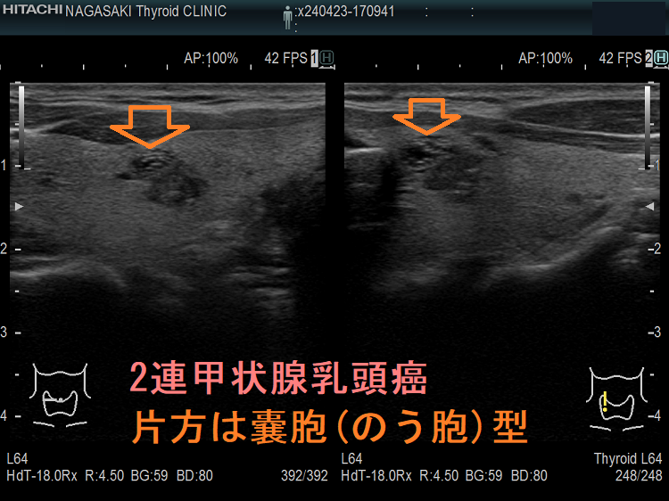 2連甲状腺乳頭癌 片方は嚢胞(のう胞)型 2連甲状腺乳頭癌 片方は嚢胞(のう胞)型