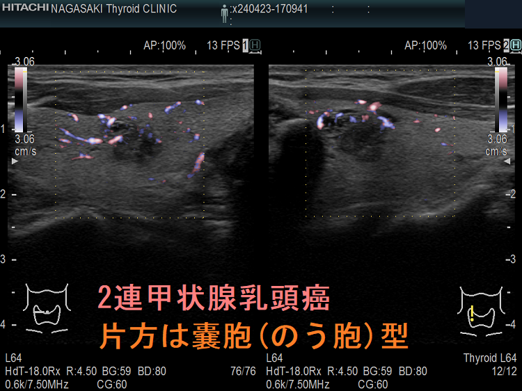2連甲状腺乳頭癌 片方は嚢胞(のう胞)型 ドプラーモード 2連甲状腺乳頭癌 片方は嚢胞(のう胞)型 ドプラーモード
