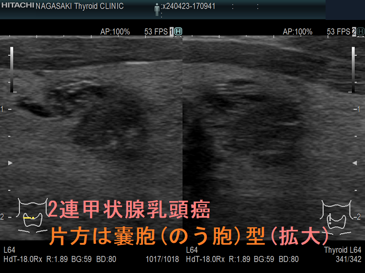 2連甲状腺乳頭癌 片方は嚢胞(のう胞)型 (拡大) 2連甲状腺乳頭癌 片方は嚢胞(のう胞)型 (拡大)