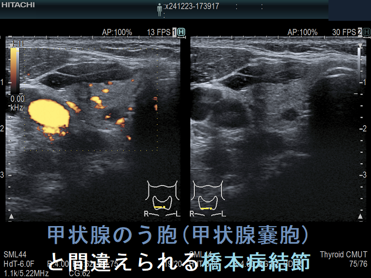 甲状腺のう胞(甲状腺嚢胞)と間違えられる橋本病結節 甲状腺のう胞(甲状腺嚢胞)と間違えられる橋本病結節