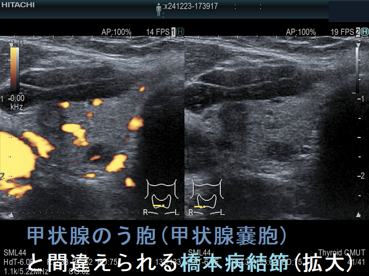 甲状腺のう胞(甲状腺嚢胞)と間違えられる橋本病結節(拡大) 甲状腺のう胞(甲状腺嚢胞)と間違えられる橋本病結節(拡大)