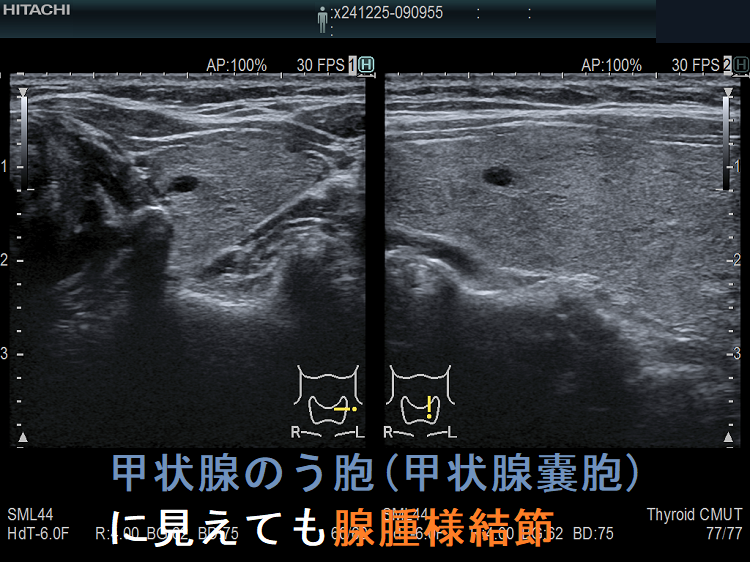 甲状腺のう胞(甲状腺嚢胞)に見えても腺腫様結節 甲状腺のう胞(甲状腺嚢胞)に見えても腺腫様結節
