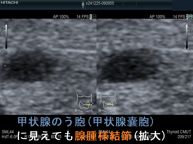 甲状腺のう胞(甲状腺嚢胞)に見えても腺腫様結節(拡大) 甲状腺のう胞(甲状腺嚢胞)に見えても腺腫様結節(拡大)