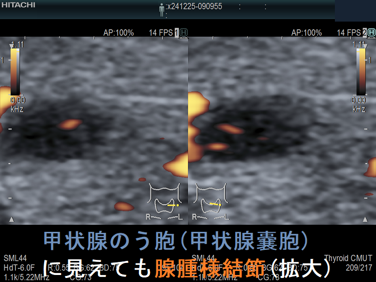 甲状腺のう胞(甲状腺嚢胞)に見えても腺腫様結節(拡大)ドプラーモード 甲状腺のう胞(甲状腺嚢胞)に見えても腺腫様結節(拡大)ドプラーモード