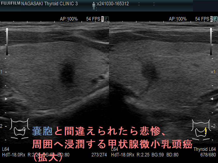 甲状腺のう胞(甲状腺嚢胞)に見えても腺腫様結節(拡大)ドプラーモード 嚢胞と間違えられたら悲惨、周囲へ浸潤する甲状腺微小乳頭癌(拡大)