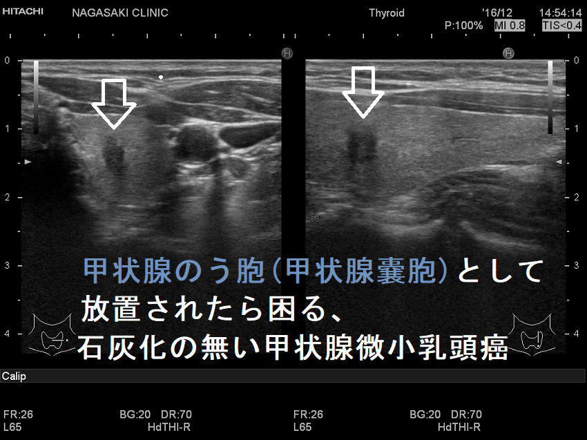 甲状腺のう胞(甲状腺嚢胞)として放置されたら困る、石灰化のない甲状腺微小乳頭癌 甲状腺のう胞(甲状腺嚢胞)として放置されたら困る、石灰化のない甲状腺微小乳頭癌