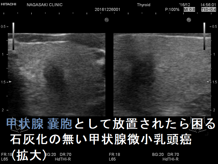 甲状腺のう胞(甲状腺嚢胞)として放置されたら困る、石灰化のない甲状腺微小乳頭癌(拡大) 甲状腺のう胞(甲状腺嚢胞)として放置されたら困る、石灰化のない甲状腺微小乳頭癌(拡大)
