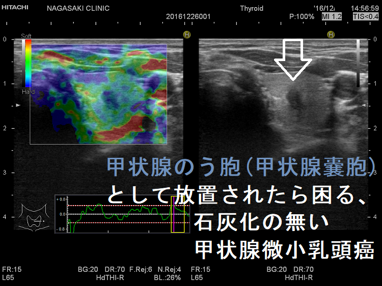 甲状腺のう胞(甲状腺嚢胞)として放置されたら困る、石灰化のない甲状腺微小乳頭癌 エラストグラフィー 甲状腺のう胞(甲状腺嚢胞)として放置されたら困る、石灰化のない甲状腺微小乳頭癌 エラストグラフィー