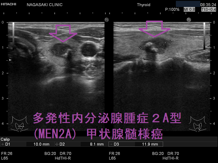 甲状腺髄様癌の超音波エコー検査[橋本病 バセドウ病 甲状腺機能