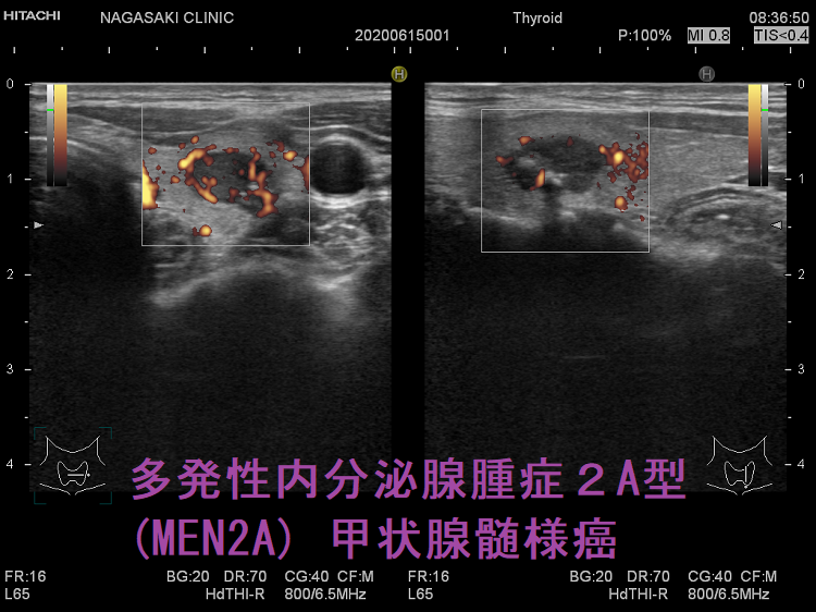 多発性内分泌腺腫症2A型(MEN2A) 甲状腺髄様癌 超音波(エコー)画像 ドプラーモード 多発性内分泌腺腫症2A型(MEN2A) 甲状腺髄様癌 超音波(エコー)画像 ドプラーモード