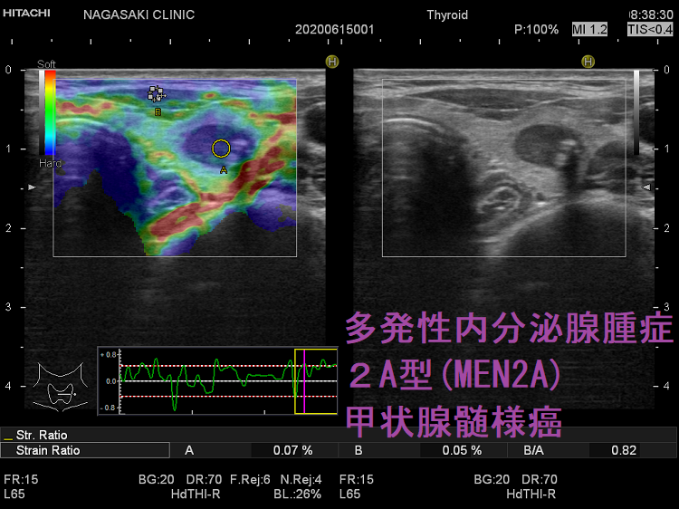 多発性内分泌腺腫症2A型(MEN2A) 甲状腺髄様癌 超音波(エコー)画像 エラストグラフィー 多発性内分泌腺腫症2A型(MEN2A) 甲状腺髄様癌 超音波(エコー)画像 エラストグラフィー