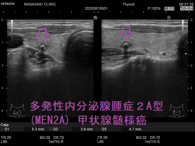 多発性内分泌腺腫症2A型(MEN2A) 甲状腺髄様癌 多発性または腺内転移 超音波(エコー)画像 多発性内分泌腺腫症2A型(MEN2A) 甲状腺髄様癌 多発性または腺内転移 超音波(エコー)画像