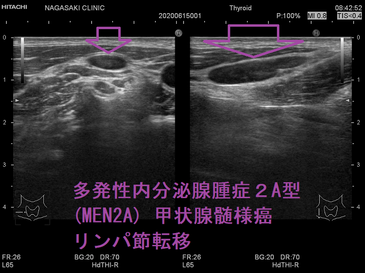 多発性内分泌腺腫症2A型(MEN2A) 甲状腺髄様癌 リンパ節転移 超音波(エコー)画像 多発性内分泌腺腫症2A型(MEN2A) 甲状腺髄様癌 リンパ節転移 超音波(エコー)画像
