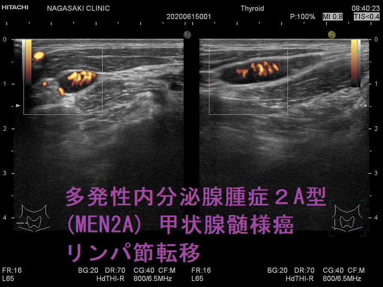 多発性内分泌腺腫症2A型(MEN2A) 甲状腺髄様癌 リンパ節転移 超音波(エコー)画像 ドプラーモード 多発性内分泌腺腫症2A型(MEN2A) 甲状腺髄様癌 リンパ節転移 超音波(エコー)画像 ドプラーモード