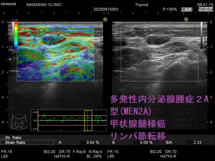 多発性内分泌腺腫症2A型(MEN2A) 甲状腺髄様癌 リンパ節転移 超音波(エコー)画像 エラストグラフィー 多発性内分泌腺腫症2A型(MEN2A) 甲状腺髄様癌 リンパ節転移 超音波(エコー)画像 エラストグラフィー