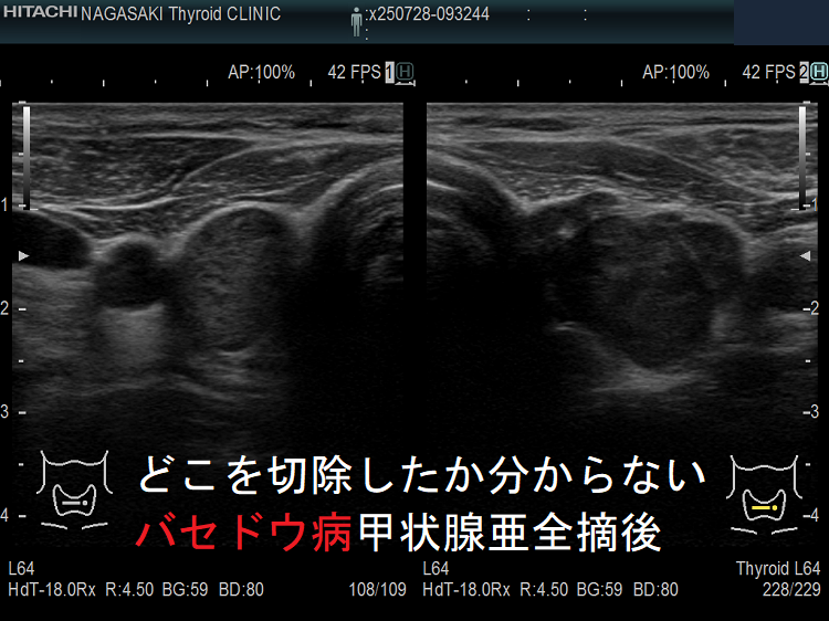 どこを切除したか分からないバセドウ病甲状腺亜全摘後 どこを切除したか分からないバセドウ病甲状腺亜全摘後