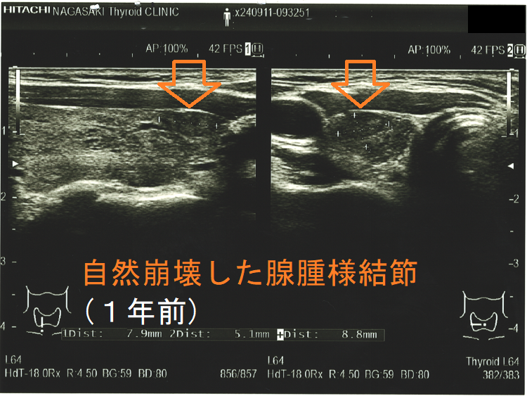 自然崩壊した腺腫様結節(崩壊1年前) 自然崩壊した腺腫様結節(崩壊1年前)
