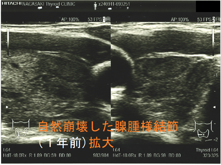 自然崩壊した腺腫様結節(崩壊1年前)拡大 自然崩壊した腺腫様結節(崩壊1年前)拡大
