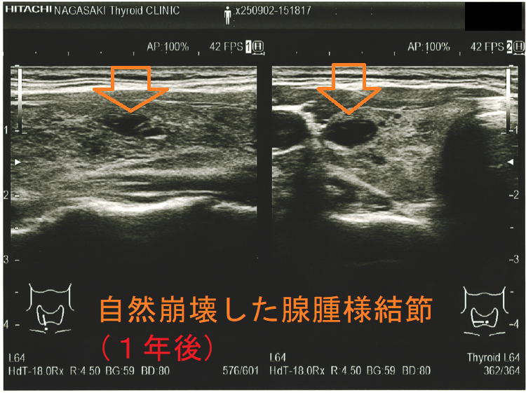 1年後に自然崩壊した腺腫様結節 1年後に自然崩壊した腺腫様結節