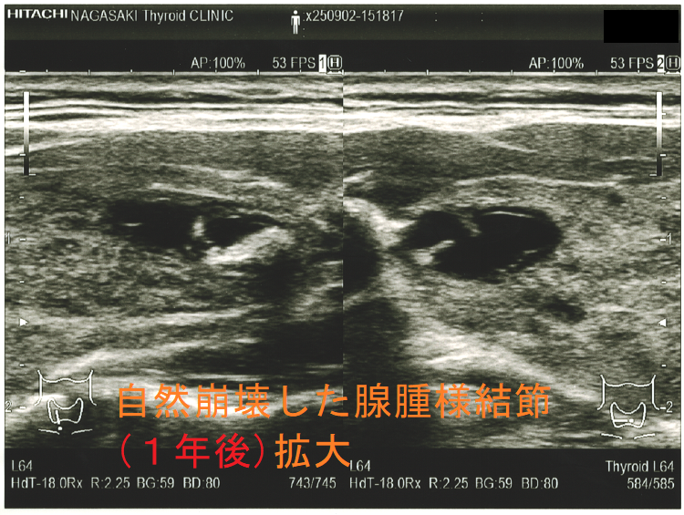 1年後に自然崩壊した腺腫様結節(拡大);内部は嚢胞化 1年後に自然崩壊した腺腫様結節(拡大);内部は嚢胞化