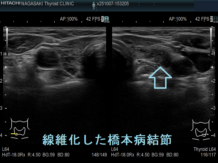 線維化した橋本病結節(水平断) 線維化した橋本病結節(水平断)