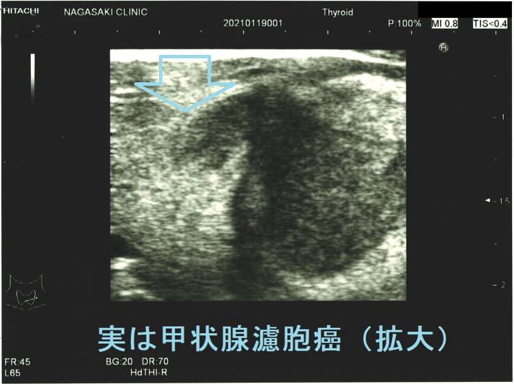 広汎浸潤型濾胞癌(拡大) 広汎浸潤型濾胞癌(拡大)