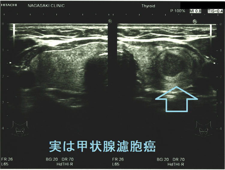 広汎浸潤型濾胞癌(水平断) 広汎浸潤型濾胞癌(水平断)