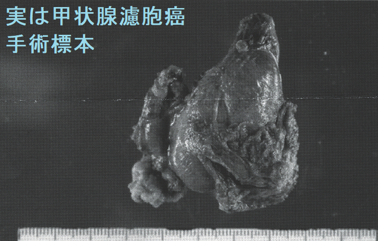 実は広汎浸潤型濾胞癌 手術標本 実は広汎浸潤型濾胞癌 手術標本2