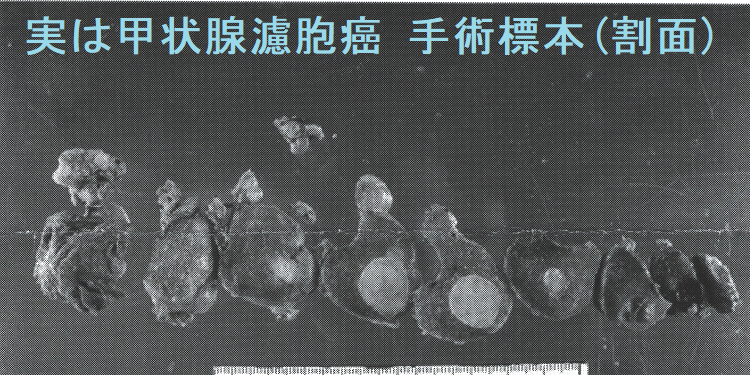 実は広汎浸潤型濾胞癌 手術標本(割面) 実は広汎浸潤型濾胞癌 手術標本(割面)
