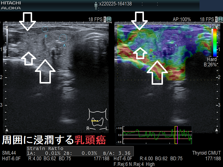 甲状腺乳頭癌が周囲の甲状腺組織に浸潤 甲状腺乳頭癌が周囲の甲状腺組織に浸潤
