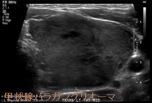 甲状腺パラガングリオーマ超音波(エコー)画像 甲状腺パラガングリオーマ超音波(エコー)画像