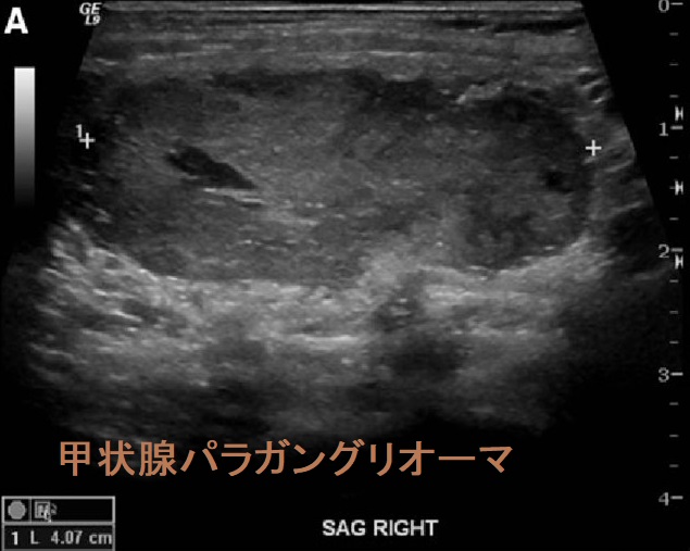 甲状腺パラガングリオーマ超音波(エコー)画像 甲状腺パラガングリオーマ超音波(エコー)画像