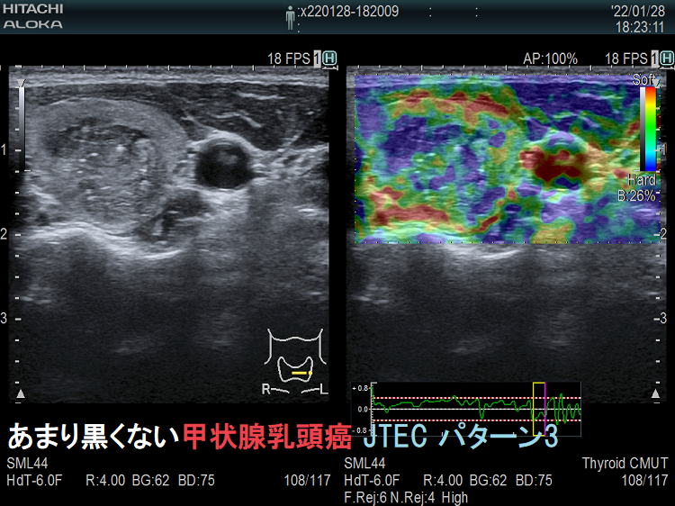 エラストグラフィー(甲状腺乳頭癌;JTEC パターン3) エラストグラフィー(甲状腺乳頭癌;JTEC パターン3)