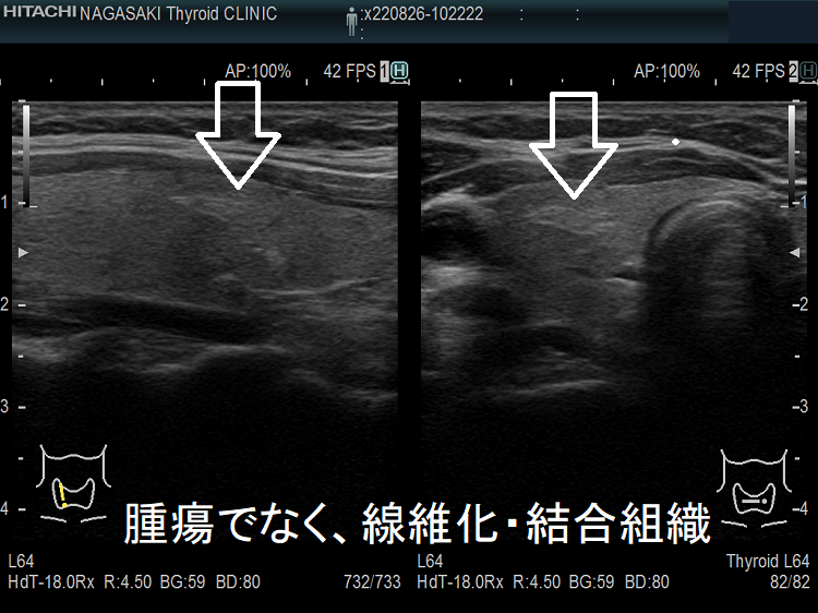 甲状腺腫瘍でなく、線維化・結合組織 超音波(エコー)画像 甲状腺腫瘍でなく、線維化・結合組織 超音波(エコー)画像
