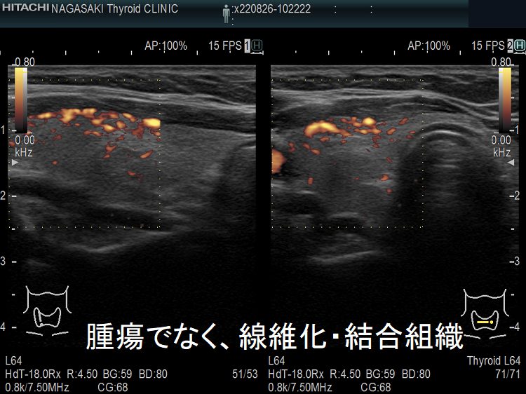 甲状腺腫瘍でなく、線維化・結合組織 超音波(エコー)画像 ドプラーモード 甲状腺腫瘍でなく、線維化・結合組織 超音波(エコー)画像 ドプラーモード