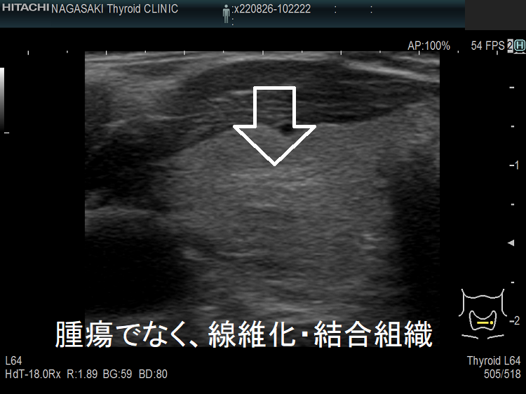 甲状腺腫瘍でなく、線維化・結合組織 超音波(エコー)画像 拡大 甲状腺腫瘍でなく、線維化・結合組織 超音波(エコー)画像 拡大