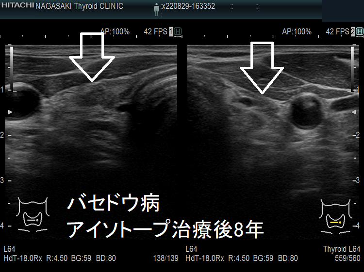 バセドウ病 アイソトープ治療後8年 超音波(エコー)画像 バセドウ病 アイソトープ治療後8年 超音波(エコー)画像