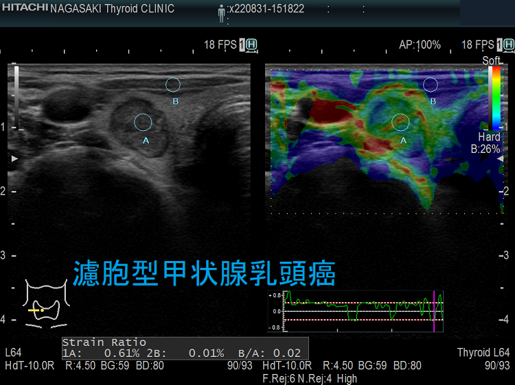 濾胞型甲状腺乳頭癌 超音波(エコー)画像 エラストグラフィー 濾胞型甲状腺乳頭癌 超音波(エコー)画像 エラストグラフィー