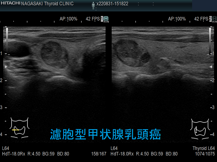 濾胞型甲状腺乳頭癌 超音波(エコー)画像 濾胞型甲状腺乳頭癌 超音波(エコー)画像